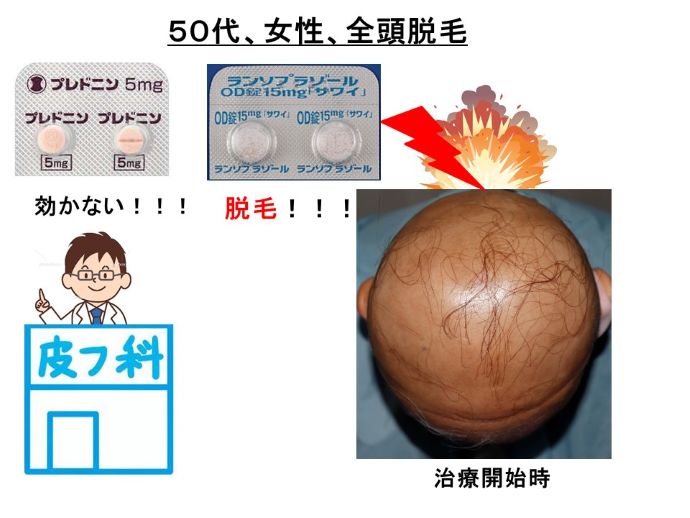 円形脱毛症　病院